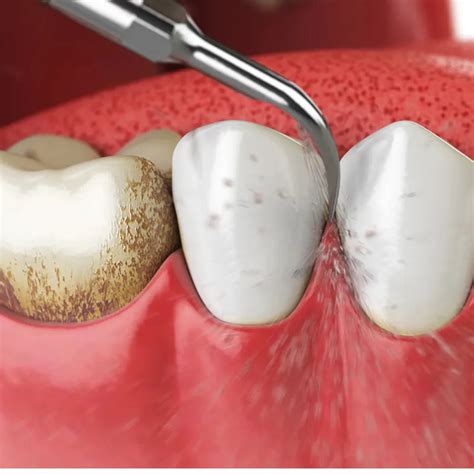 Woodpecker Endodontic Scaler Tips for DTE & Satelec Scalers – Dentaid ...