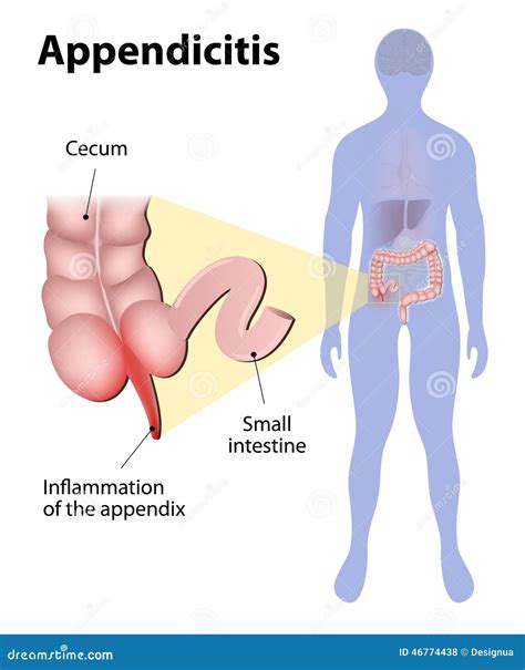 Image result for Appendix Inflammation