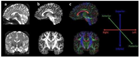 Diffusion Tensor Imaging as a Prognostic Tool for Recovery in Acute and ...