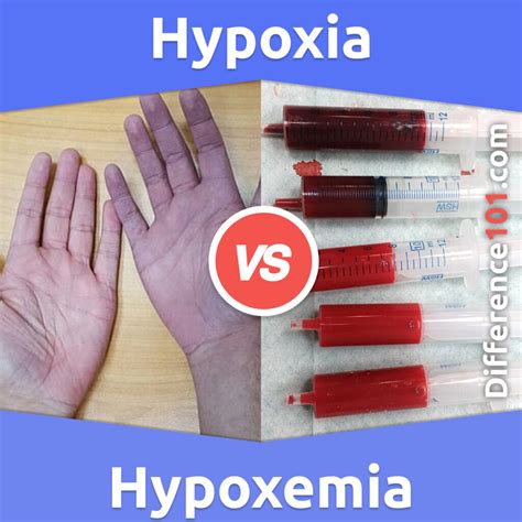 Hypoxia vs. Hypoxemia: 5 Key Differences, Pros & Cons, Similarities | Difference 101