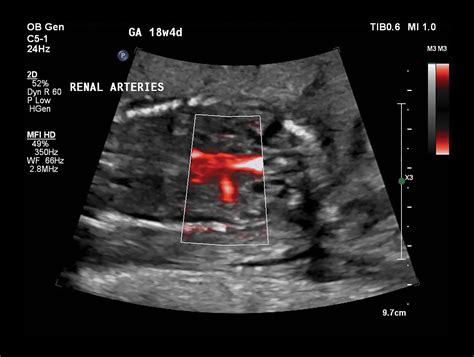 Advancing prenatal diagnostic ultrasound - Philips