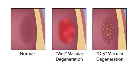 Macular Degeneration Treatment in California | AMD