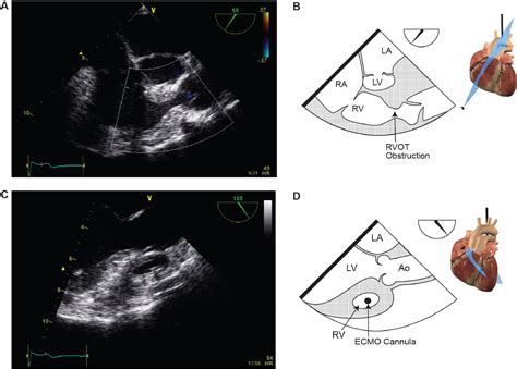 Right Ventricular Outflow Tract Obstruction in Adults: A Systematic ...