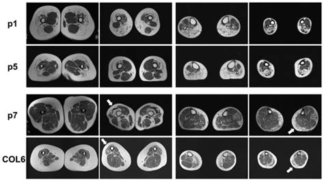 IJMS | Special Issue : Molecular Advances in Neuromuscular Disorders ...