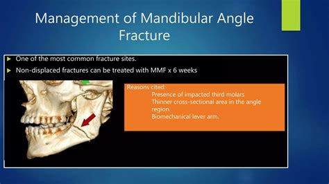 Management of Mandibular Fractures | PPTX