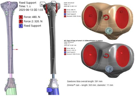 Stress Distribution in Interlocking and Blocking Screw Fixation for ...