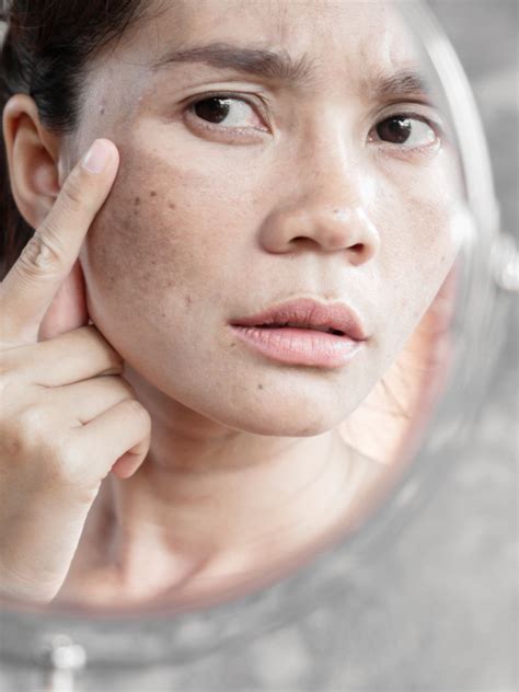 Two nutrient deficiencies that can lead to hyperpigmentation