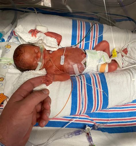 Mastitis : r/ExclusivelyPumping