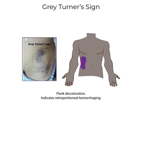 Grey Turner Pancreatitis