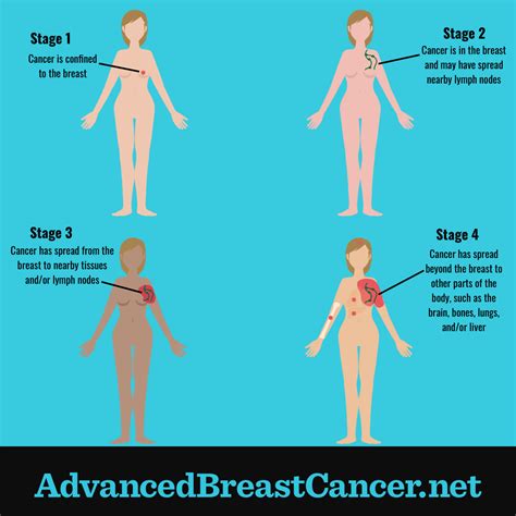 Inflammatory Breast Cancer Stage 1