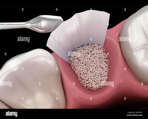 Tooth Extraction Piece Of Bone at Nancy Jensen blog