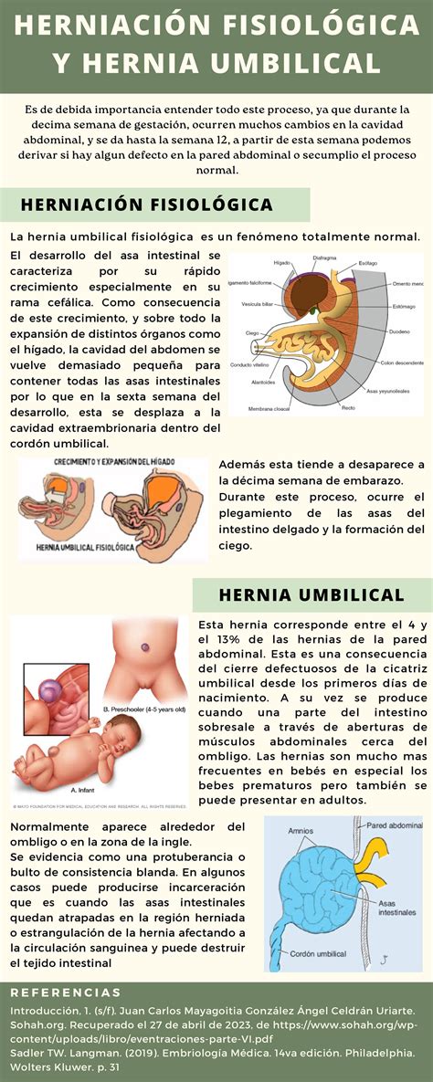 Infografía Herniación Fisiológica y Hernia umbilical - Esta hernia corresponde entre el 4 y el ...