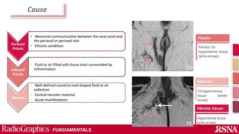 Perianal fistula and Abscess.pptx