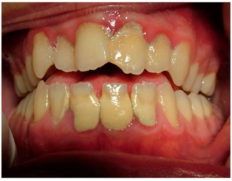 Periodontal Disease and Vitamin D Deficiency in Pregnant Women: Which ...