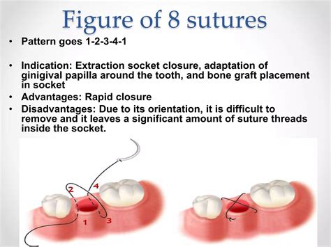 Suturing techniques involved in dental surgery | PPTX