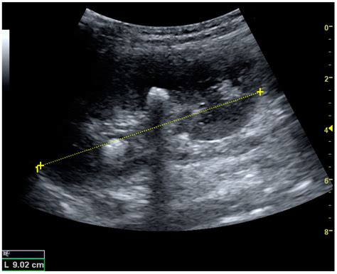 Kidney Stones Ultrasound
