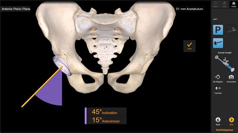 Anterior Approach to Hip Replacement in Ahmedabad