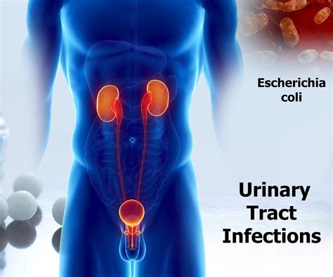 Urinary Tract Infection Hospital Treatment at Alma Jones blog