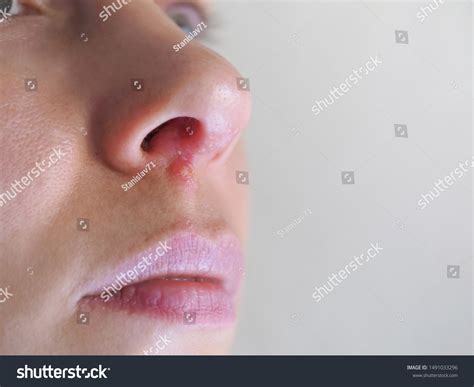 Herpes In Nose