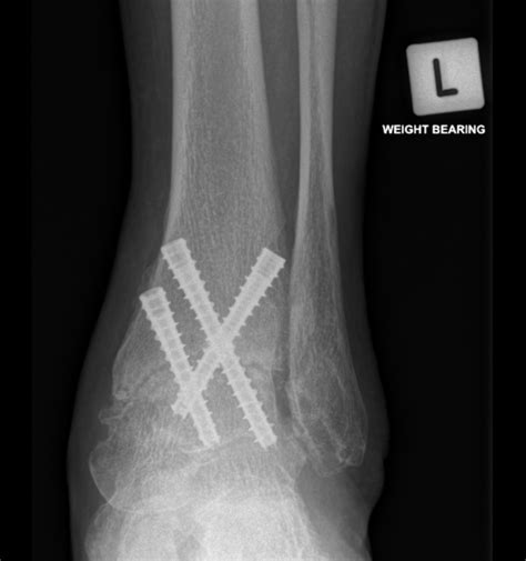 Fused Ankle Bones