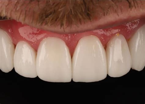 Gum Abscess Popped? Thinking of Popping It Yourself?