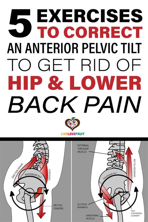7 anterior pelvic tilt exercises to fix painful lower back – Artofit