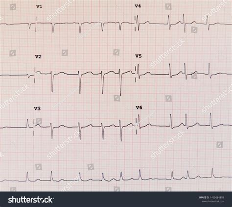 15 Atrial Fibrillation Rhythm Strip Images, Stock Photos & Vectors ...