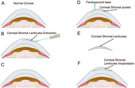The Preservation and Reuse of Lenticules Extracted via Small Incision ...