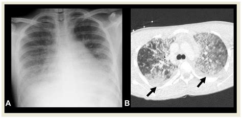 Imaging of Acute Complications of Community-Acquired Pneumonia in the ...