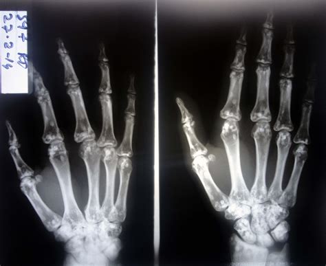 X Ray Of Hand