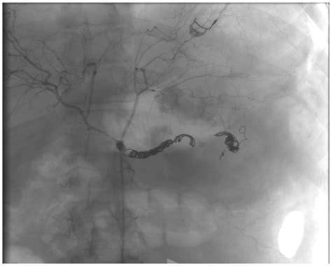 Endovascular and Open Surgical Treatment of Ruptured Splenic Artery ...