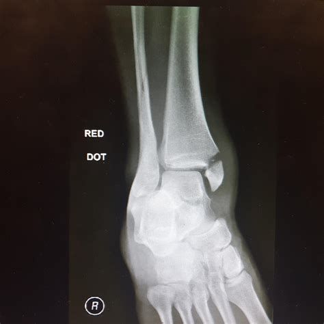 Broke my ankle playing ice hockey, thought I'd post the x-ray here for anyone who's interested ...