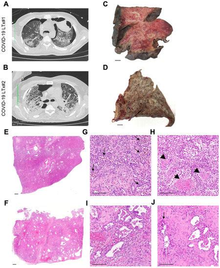 Emergency Lung Transplantation after COVID-19: Immunopathological ...