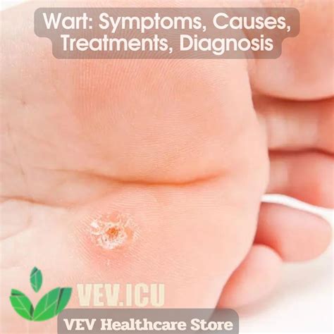 Wart: Symptoms, Causes, Treatments, Diagnosis