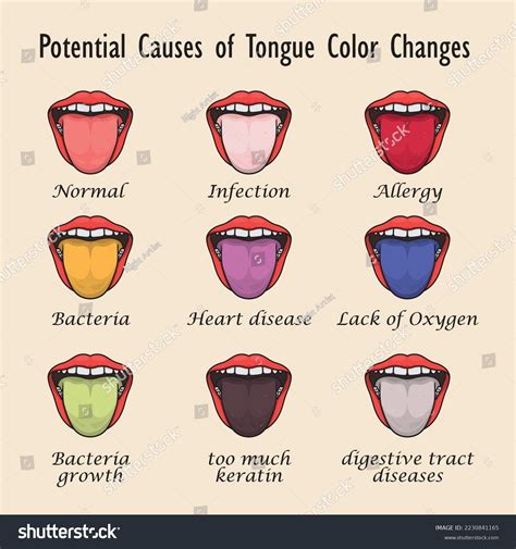 Tongue Health Signs Diagnosis Medical Inspection Stock Vector (Royalty Free) 2230841165 ...