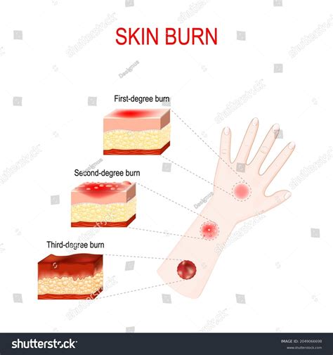 First Second And Third Degree Burns