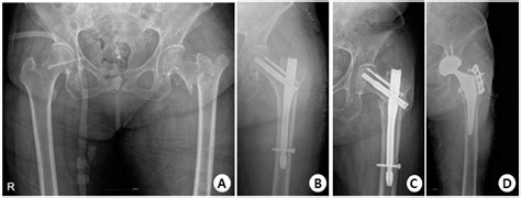 GS Hip Nail versus Affixus Hip Fracture Nail for the Intramedullary ...