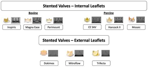 Transcatheter Aortic Valve Implantation to Treat Degenerated Aortic ...