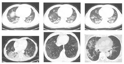 Overview of COVID-19 Disease: Virology, Epidemiology, Prevention ...