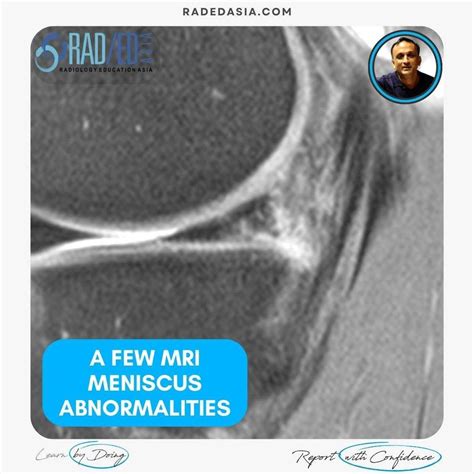 A FEW MRI MENISCUS ABNORMALITIES: MENISCUS TEAR, INTRA MENISCAL CYST AND VARIANTS THAT LOOK LIKE ...