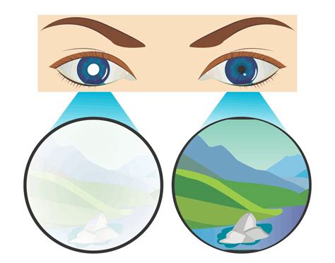 Lazy Eye Surgery: Procedure and Costs - Vision Center