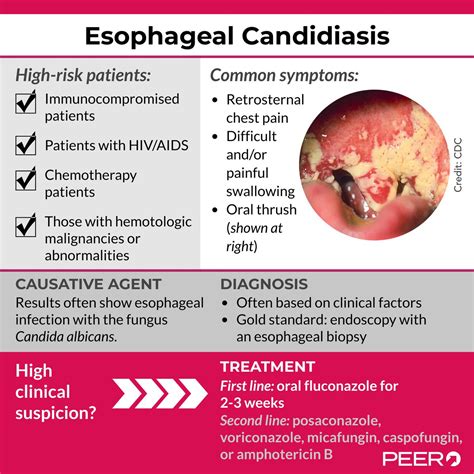 Esophageal Candidiasis