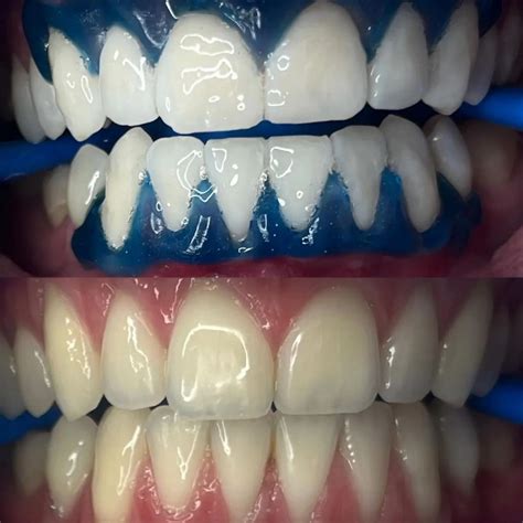 Why Is Professional Teeth Whitening So Expensive?