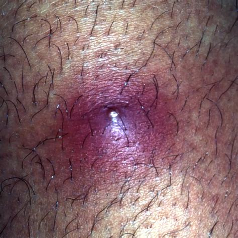 14 Causes of a Pimple-Like Rash