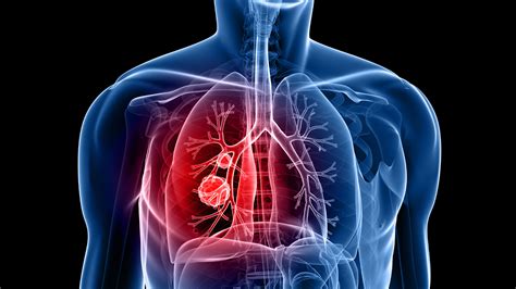 What Does Lung Nodules Mean | OneWelbeck Lung Health