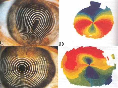 Pellucid marginal degeneration | PPT