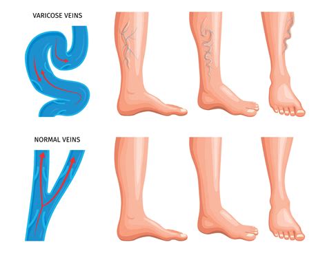 Feet Veins Anatomy at Donna Kovach blog