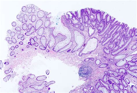 Pathology Outlines - Tubular adenoma