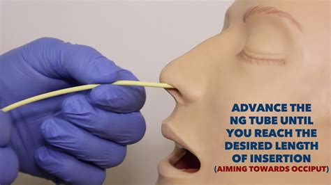 Nasogastric (NG) Tube Insertion - OSCE Guide | Geeky Medics