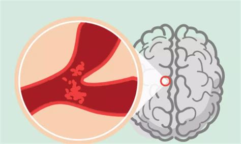 Brain stimulation promising treatment for patients with acute ischemic ...
